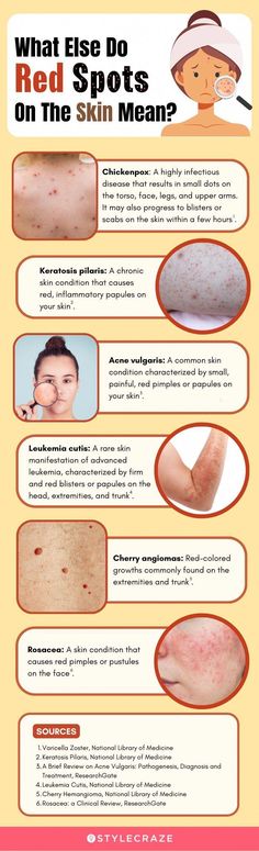 Red spots on the face can give you a blotchy and uneven skin tone. This article offers holistic and natural home remedies to reduce their appearance. Read on! Cherry Angioma Removal, Red Spots On Skin, Red Spots On Face, Red Skin Spots, Drawing Dots, Spots On Skin, Redness Pimple, Back Acne Remedies, Prevent Pimples