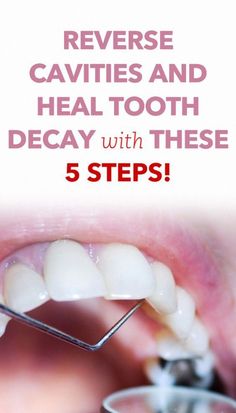 Best Reverse Cavities Method.If You are Struggling with cavities problem must try this at home.Click on the pin and watch the video that will change your life. #cavities#toothdecay#recedinggums#oral#oralhealth #whitingteeth #teethwhiting #teethcare #healthyteethtips #healteethnaturally #healthygumsandteeth #teethremedies #tipsforhealthyteeth #toothdecaycure #toothproblem #gumproblems #toothdecaytreatmentathome_ #ProDentim #TeethWhitening #HealthyTeethAndGums #DentalHealth #DentalCare #FreshBreath Fix Teeth, Teeth Remedies, Reverse Cavities, Tooth Decay Remedies, Dental Health Care, Oral Care Routine, Gum Care, Receding Gums, Teeth Care