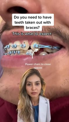 Braces Tips, Tooth Decay Remedies, Dental Cavities, Tooth Sensitivity, Stronger Teeth, Oral Care Routine, Gum Care, Oral Health Care, Tooth Decay