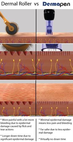 Desde hace aproximadamente un año, se ha  empezado a escuchar en nuestro país, las maravillas de la Mesopen. La Mesopen es una terapia cuyos resultados son equiparables a la mesoterapia de inyecciones de hialurónico, colágeno, vitaminas y Bótox pero con menos riesgos y pudiéndose realizar en casa cómodamente siguiendo un sencillo protocolo. Los resultados se …