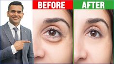 Under Eye Bags Treatment That Works In 2 Minutes - Dr. Vivek JoshiLink of my website https://weherbal.in/collections/frontpage 100%  Organic Moringa  Powder ... Remove Under Eye Bags, Droopy Eyes, Skincare For Oily Skin, Moringa Powder, Dark Underarms, Remove Dark Circles, Hygiene Routine, Dark Circle, Eye Wrinkle