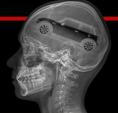 an x - ray image of a car in the head