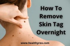 People don't remove skin tags only for cosmetic or aesthetic reasons. If you develop skin tags regularly and on multiple parts of the body, Causes Of Skin Tags, Skin Tags On Face, Castor Oil For Skin, Remove Skin Tags Naturally, Healthy Book, Home Remedies For Skin