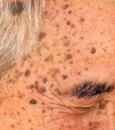 Homeopathic medicines stop the further progression of skin lesions in seborrheic keratosis and gradually reduce the size  number of skin growths. Age Spot Remedies, Skin Lesions, Brown Spots On Skin, Health Signs