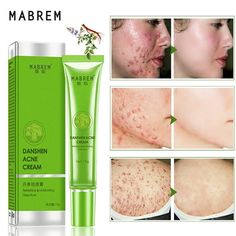 MABREM Repair Acne Cream Extract Acne Removal Scars Marks Treatment Facial Feature: Contains Danshen mild acne ingredients Refreshing and not greasy, easy to absorb non-greasy, clean pores greasy, soothes acne muscles Replenishes skin with nutrients and moisture, improves skin dryness and roughness Finely condenses pores Leaves skin supple and smooth, showing Fine and shiny. Describe: Name: Acne removing cream Net:15g Weight:35g Size of box:12x3x3.5 cm INGREDIENT:WATER,PROPYLENE GLYCOL,CETEARYL Mild Acne, Acne Removal, Natural Acne Remedies, Acne Oil, Acne Scar Removal, Acne Facial, Acne Cream, Moisturizer For Oily Skin, Skin Dryness