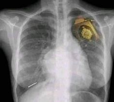 an x - ray image shows the chest and lung area, with a small piece of gold in it