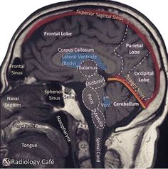 an image of the inside of a human brain with labels in red and black on it