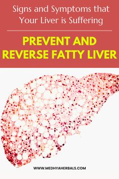 reverse fatty liver, liver healthy foods, healthy liver, natural remedies for liver health