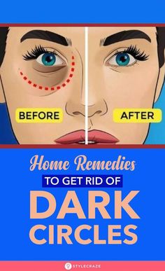 Dark circles under eyes can be a problem, especially if they are persistent. Read on to know more about this issue and how you can treat them naturally at home. Super Dry Skin Remedies, Remedies For Dark Circles, Fuller Lips Naturally, Beauty Hacks That Actually Work, Dark Circle Remedies, Super Dry Skin, Dry Skin Remedies, Concealer For Dark Circles