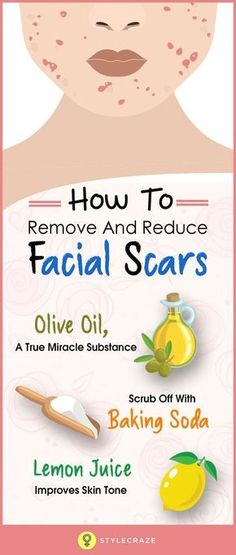 Girls who have oily and acne-prone skin, might suffer from the embarrassment caused by acne scars. Not only oily-skinned women but even combination skinned girls stand the chance of suffering from acne and acne scars. Acne tends to mellow down eventually Make Up Diy, Facial Scars, Acne Scar Removal, Remove Stains, Scar Removal, Improve Skin Tone, How To Get Rid Of Acne