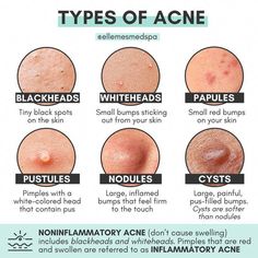 Amazon.com: skin care routine Different Types Of Acne, Skincare For Combination Skin, Haut Routine, Skin Facts, Skin Advice, Clear Healthy Skin, Types Of Acne, Basic Skin Care Routine, Skincare Organization