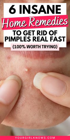 Get Rid Of Pimples Overnight, Rid Of Pimples Overnight, Get Rid Of Pimples, Acne Treatment Overnight, Rid Of Pimples