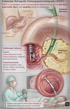 the endoscopic retode is shown in this diagram