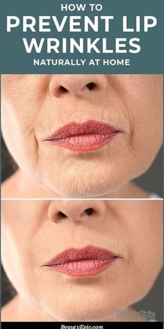 Nowadays, skin problems are the main issues for people. There are many people who have suffered with the problem of lip wrinkles.#wrinkle #wrinkleremover #wrinklesremediesface #wrinkles #wrinklesaroundmouth #wrinklearoundmouth #wrinkletreatment #howtogetridofrinkles #HOWTOREMOVEWRIKLE #wrinklecream #USA #UNITEDSTATES #UNITEDKINGDOM #CANADA Derma Fillers, Lip Wrinkles, Neck Wrinkles, Forehead Wrinkles, Glow Skin