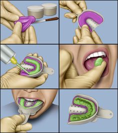 Dental Impressions - http://brushflossandmouthwash.com/sonicare-vs-oral-b/ Dental Hygiene Student, Best Dental Implants, Kedokteran Gigi, Kesehatan Gigi, Dentistry Student, Dental Anatomy