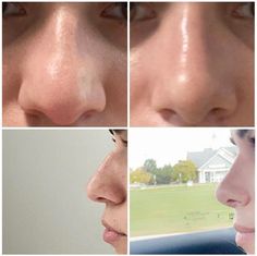 Nose Job Front View, Perfect Nose Front View, Nose Front View, Bella Hadid Nose, Nose Filler, Kpop Plastic Surgery, Jaw Reduction Surgery, Nose Surgery Rhinoplasty, Nose Fillers