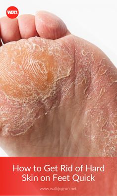 Peeling Skin On Feet How To Get Rid Of, Heel Callus Remover Diy, How To Get Rid Of Dry Skin On Feet Heels, How To Get Dry Skin Off Feet, Peeling Feet Remedy Diy, Dry Feet How To Get Rid Of, Coconut Oil For Feet Dry Skin, How To Get Rid Of Dry Feet Skin, Feet Cracks Remedies