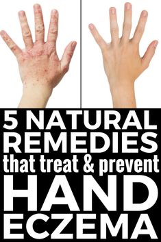 5 Natural Hand Eczema Remedies that Work! There are different types of hand eczema, and the causes can vary from person to person, but on thing is certain: itchy, red, raw, weeping, and dry skin can be pretty miseral. Check out our best tips and natural products that help treat and prevent hand eczema in the winter and beyond and say YES to beautiful skin! #eczema #psoriasis #itchy #skin #dermatitis #remedies #naturalremedies #handeczema Skin Peel, Skin Cream Anti Aging, Cleansing Mask, Charcoal Mask, Mask Diy, Acne Remedies, Skin Toner