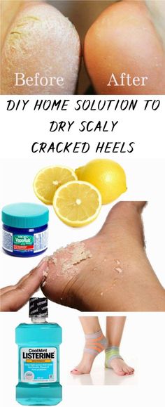 Cracked Heels not only affects the beauty of your foot but also prove to be very painful in intensive cases.These cracks are generally caused by insufficient moisture.The most common reasons for Heel Fissures are mainly walking barefooted, excessive hot showers, prolonged standing,climate,age, medical conditions etc. Obličejové Masky, Excellent Health, Vicks Vapor Rub, Vicks Vapor, Vapor Rub, Cracked Heels, Beauty Remedies, Skin Remedies, Homemade Beauty Products