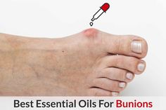 Can Essential Oils Help To Heal Bunions? Essential Oil Benefits Acid Reflux Diet Meals, Nail Remedies, Reflux Diet, Herbal Remedies Recipes, Acid Reflux Diet, Weak Nails, Mint Oil, Foot Pain Relief, Diet Meals