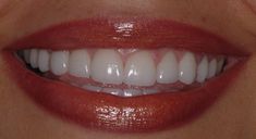 Perfect Teeth Aesthetic, Natural Veneers, Short Teeth, Teeth Aesthetic, Pretty Teeth, Veneers Teeth, Discolored Teeth, Beautiful Teeth, Porcelain Veneers