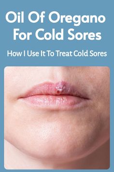 Save this pin to learn how I use oil of oregano for cold sores. If you’re looking for a natural cold sore remedy that packs a punch, this might become one of your favorites, too.