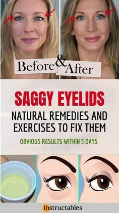 Saggy Eyes, Saggy Eyelids, Droopy Eyelids, Aging Beauty, Helpful Things, Natural Healing Remedies, Diy Remedies, Women Health, Natural Therapy