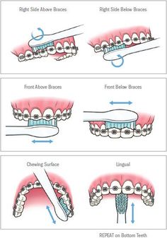 Dental Braces Colors, Braces Food, Kawat Gigi, Cute Braces Colors, Braces Tips, Getting Braces, Organizator Grafic, Kesehatan Gigi