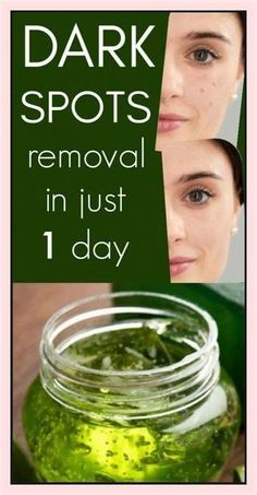 I’m SHOCKED It Removed My Dark Spots In 3 Days, Magic Remedy Dark Spots Removal, Home Remedies For Wrinkles, Dark Spots Remedies, Wrinkle Free Skin, Dark Spots On Face, Brown Spots Removal, Brown Spots On Face, Dark Spots On Skin, Skin Care Wrinkles