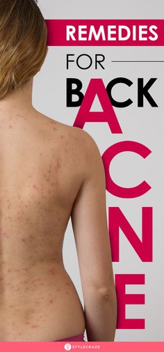 Back Acne, Back Acne Treatment, Acne Prone Skin Care, Lotion For Oily Skin, Home Remedies For Acne, Body Acne, Skin Care Wrinkles