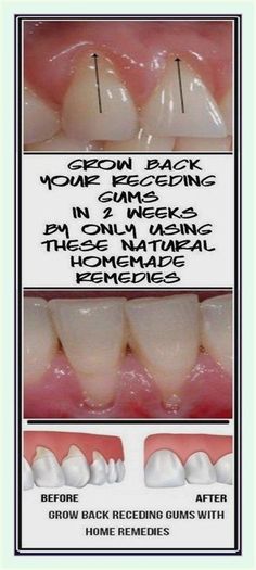 I can’t thank you enough. Exceptional information. Grow Back Receding Gums, Autogenic Training, Heal Cavities, Teeth Health, Tooth Sensitivity, Receding Gums, Oral Health Care, Homemade Remedies, Tooth Decay