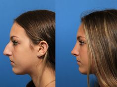 finding the platform of non surgical nose job near me that backing off all other unreliable platforms would always be preferable Nonsurgical Nose Job Before And After, Nose Filler Before After Non Surgical, Rhinoplasty Before After, Nose Job Before And After, Jaw Reduction Surgery, Nonsurgical Nose Job, Plastic Surgery Fail