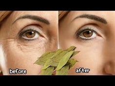 Face Wrinkles Remedies, Wrinkles Remedies Face, Natural Face Lift, Wrinkle Remedies, Natural Skin Care Remedies, Natural Face Skin Care, Skin Care Wrinkles, Face Wrinkles, Beauty Tips For Skin