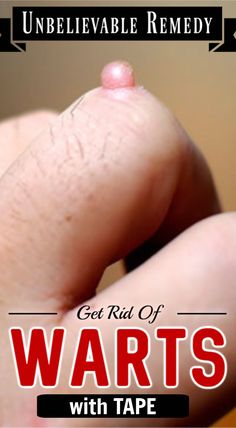 Unbelievable, You Can Remove Warts From Your Body Only With Tape #skin #skincare #selfcare #selfcarebeautytips #selfcaretips #clearskin #warts #tape #body #WaysToRemoveWarts #WhatIsTheBestWayToRemoveWarts #HowToRemoveWartsOnNeck #WartsNoMore Coldsore Remedies Quick, Warts On Face, Remove Warts, Get Rid Of Warts, Home Remedy For Cough, Cold Sores Remedies, Natural Health Care, Natural Cold Remedies, Natural Cough Remedies