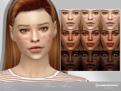 The Sims Resource - Flora Acne Acne Mod Sims 4, Sins 4 Skin Details, Sims 4 Cc Acne Maxis Match, The Sims 4 Acne Cc, Sims 4 Facial Presets, Sims 4 Skin Details Acne, Ts4 Acne Cc, Pimples Sims 4 Cc, Sims 4 Cc Imperfections