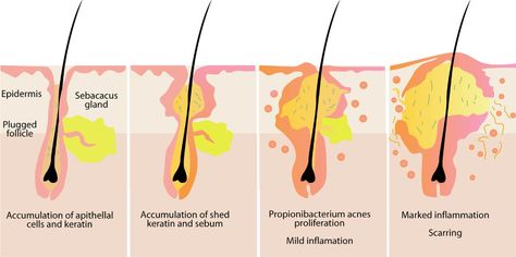 cystic-back-acne-pict-cystic-acne-diagram-medical-anatomy-… | Flickr Remedies For Pimples, Overnight Acne Remedies, Pimples Under The Skin, Pimples Remedies, Acne Vulgaris, Acne Causes, Acne Solutions, Cystic Acne, Acne Free