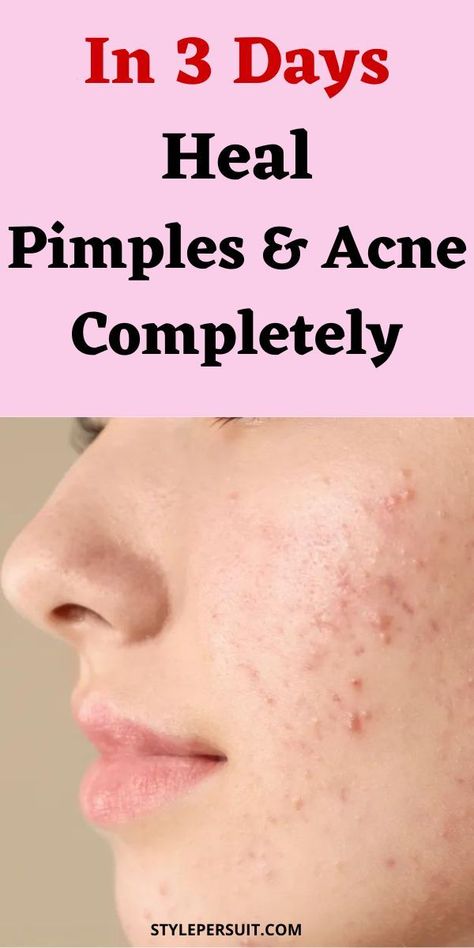 Do you really want to know how to get rid of pimples overnight fast? You have probably tried several pimple treatments and recommendations from friends without much success. You can now relax because we are going to give you effective pimple remedies that will help you say goodbye to pimples once and for all. Whether you have pimples on face, pimples on scalp, chin, on buttocks, or under the skin, you will be able to remove them easily. Click to get these effective pimple remedies overnight. How To Get Rid Of Pimples Overnight Fast, Pimples On Face Removal, How To Get Rid Of Pimples Fast, Pimples On Face Meaning, How To Get Rid Of Pimples Overnight, Pimple Remedies Overnight, Hard Pimple, Pimple Remedies, Pimples On Scalp