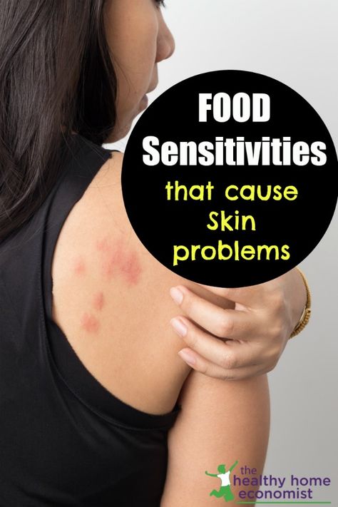 Check out this post from The Healthy Home Economist and learn how food can affect your skin. Food sensitivities are dramatically on the rise and the same can be said for skin disorders. Looking back even a decade ago, being sensitive to some kinds of food was not the hot topic that it is today. Going back 50 years ago, it was virtually unheard of! #healthy #foodsensitivities #skinproblems #causes #issues #skin Autoimmune Skin Disorders, Welts On Skin, Psoriatic Skin Diet, Food Allergy Rash, Cosmetic Nursing, Being Sensitive, Remove Skin Tags Naturally, Histamine Intolerance, Gluten Allergy