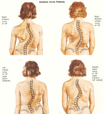 Mild Scoliosis Hypermobility Exercises, Neuroplasticity Exercises, Spinal Decompression, Piriformis Stretch, Cervical Traction, Physical Therapy Exercises, Lower Back Pain Exercises, Heath And Fitness, Back Pain Exercises