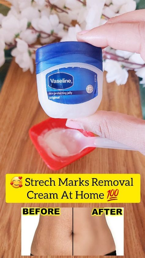 Strech Marks Removal Cream At Home 🏡 . . Ingridents ✅ Vaseline Aloevera gel Vitamin E pill Vitamin A pill Coconut oil . . Follow for… | Instagram Strech Marks Removal, Natural Hair Removal Remedies, Coconut Oil Mask, Strech Marks, Marks Cream, Hairstyles Pigtails, Braids Volleyball, Stretch Mark Cream, Stretch Mark Removal