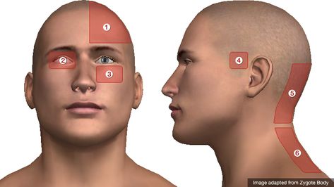 Headache Location Meaning, Headache Location, Headache Chart, Emergency Medicine, Pelvic Pain, Chest Pain, Abdominal Pain, Canning Recipes, Blood Vessels