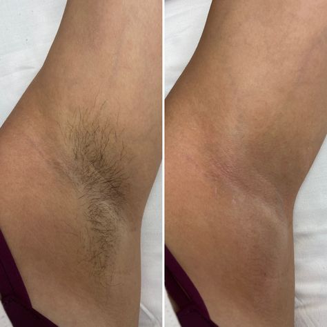 Wax Before After, Waxing Before And After, Body Wax Aesthetic, Waxing Underarms, Waxed Legs, Waxing Content, Waxing Aesthetic, Waxing Armpits, Female Waxing