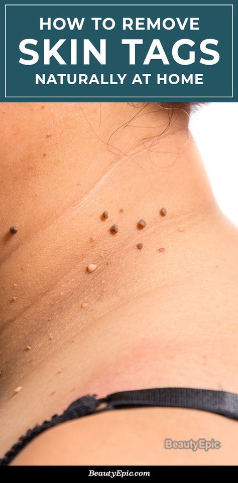 Remove Skin Tags, Remove Skin Tags Naturally, Mole Removal, Skin Tags, Home Remedy For Cough, Cold Sores Remedies, Natural Sleep Remedies, Natural Cold Remedies, Cold Home Remedies