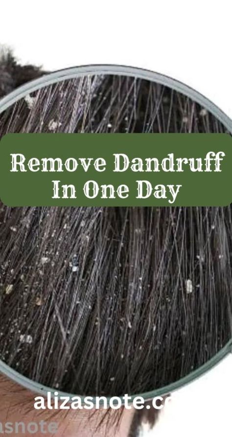 Remove Dandruff In One Day How To Remove Dandruff, Hair Growth Mask Diy, Apple Cider Vinegar Hair Rinse, Dandruff Solutions, Home Remedies For Dandruff, Vinegar For Hair, Rid Of Dandruff, Apple Cider Vinegar For Hair, Dandruff Flakes