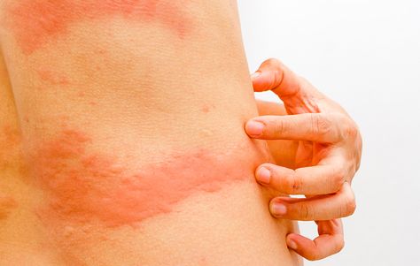 Consider this scenario: You just got back from an adventure vacation and are... Rash On Stomach, Heat Rash Remedy, Home Remedies For Rashes, Rash On Hands, Types Of Skin Rashes, Leg Rash, Common Skin Rashes, Fungal Rash, Itchy Skin Rash