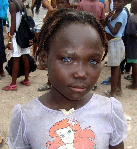 Waardenburg Syndrome - a person with this syndrome will also normally have a nose that looks like a ski slope, with no dip or bump.  Often the upper lip is missing the cupid's bow. Black With Blue Eyes, Girl With Blue Eyes, People With Blue Eyes, Beautiful Blue Eyes, We Are The World, Natural Phenomena, People Of The World, African Beauty, Pretty Eyes