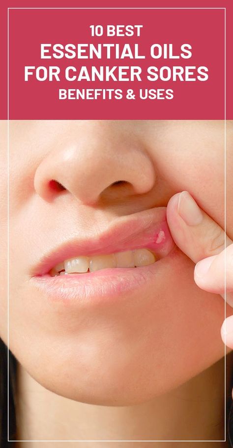 Essential Oils For Mouth Ulcers, Essential Oil For Canker Sore In Mouth, Essential Oils Canker Sore, Sore In Mouth Remedies, Canker Sore Remedies, Gum Sores, Canker Sore Relief, Canker Sore Remedy, Essential Oil Roller Bottle Recipes