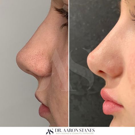 Lip Filler Before And After Side Profile, Cute Noses Profile, Side Nose Profile, Small Alar Base Nose, Lip Fillers Side Profile, Front Nose Profile, How To Fix Your Side Profile, Chin Side Profile, Noses Side Profile