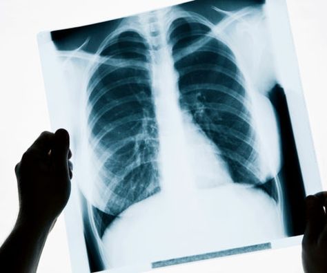 Called ChexNet, an algorithm can accurately diagnose a range of diseases from chest X-rays, reducing human error in radiology with machine learning. Chest X Ray, X Ray Machine, Bad Cough, X-ray Images, How To Help Nausea, Chronic Cough, Medical Imaging, X Rays, Bear With Me