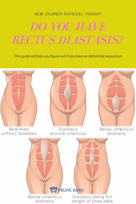 Do I have rectus diastasis? How to know if you have a gap and to start the recovery process Diastasis Recti Looks Like, Severe Diastasis Recti, How Do You Know If You Have Diastasis Recti, How To Check For Diastasis Recti, How To Fix Diastasis Recti Years Later, Diastis Recti Before And After, How To Avoid Diastasis Recti, Diastasis Recti C Section, Correcting Diastasis Recti